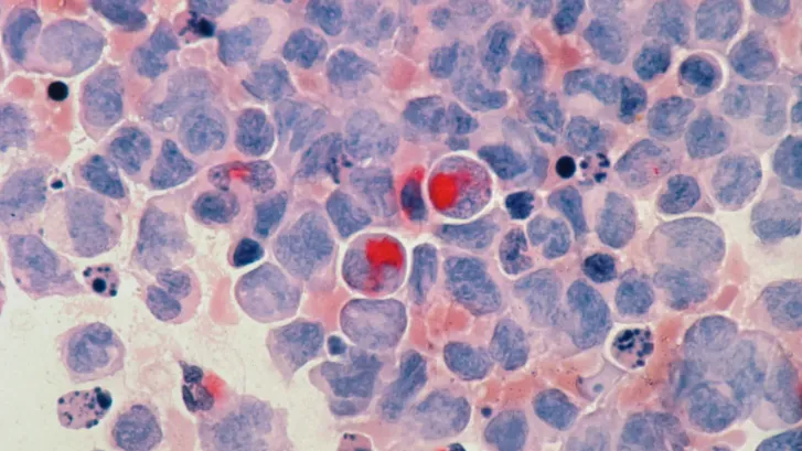 Rising elderly cancer burden to expand T-cell malignancies market