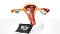 Uterine fibroids treatment devices market eyes 9% CAGR growth until 2032