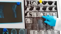 St. Luke’s Medical Center rolls out rapid AI for stroke diagnosis