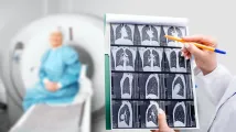 AI shows potential in managing idiopathic pulmonary fibrosis: report