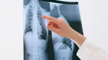 Chronic conditions fuel demand as pneumonia market expands