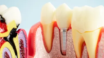 India’s dental implant and abutment market to grow 6% annually until 2034