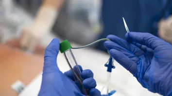 Cryoablation market to decline sharply by 2026