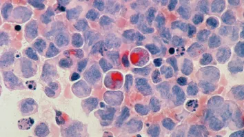 $2.17b AI surge projected by 2034 amidst pursuit to end missed cancer diagnoses