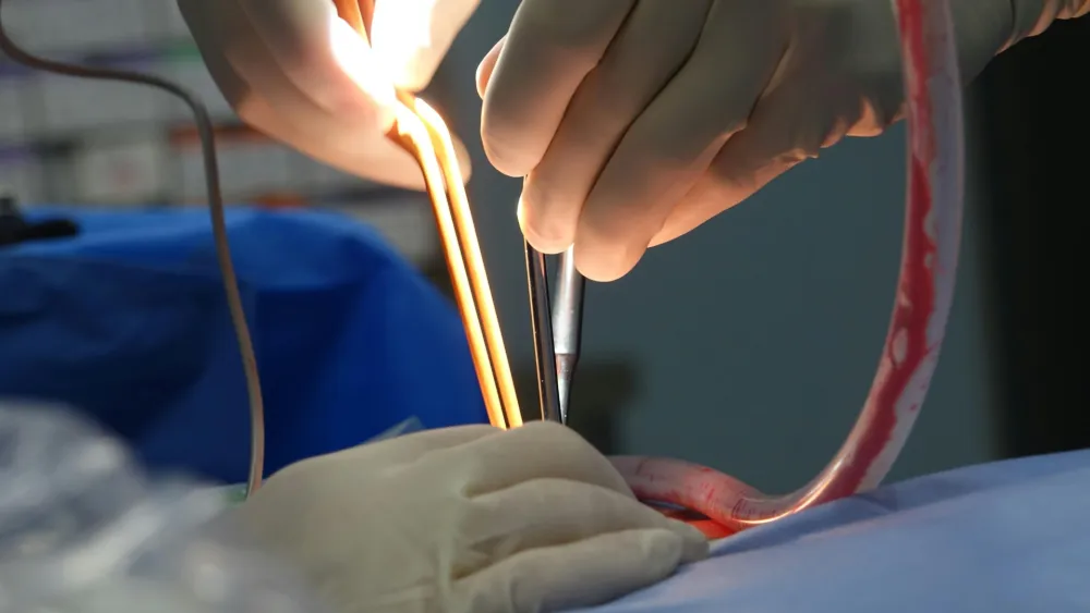 How can Asia expand bowel cancer screening as deaths rise?