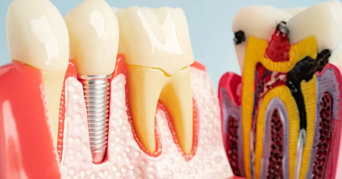 Minimally invasive tech and awareness drive dental implants $12.6b ...